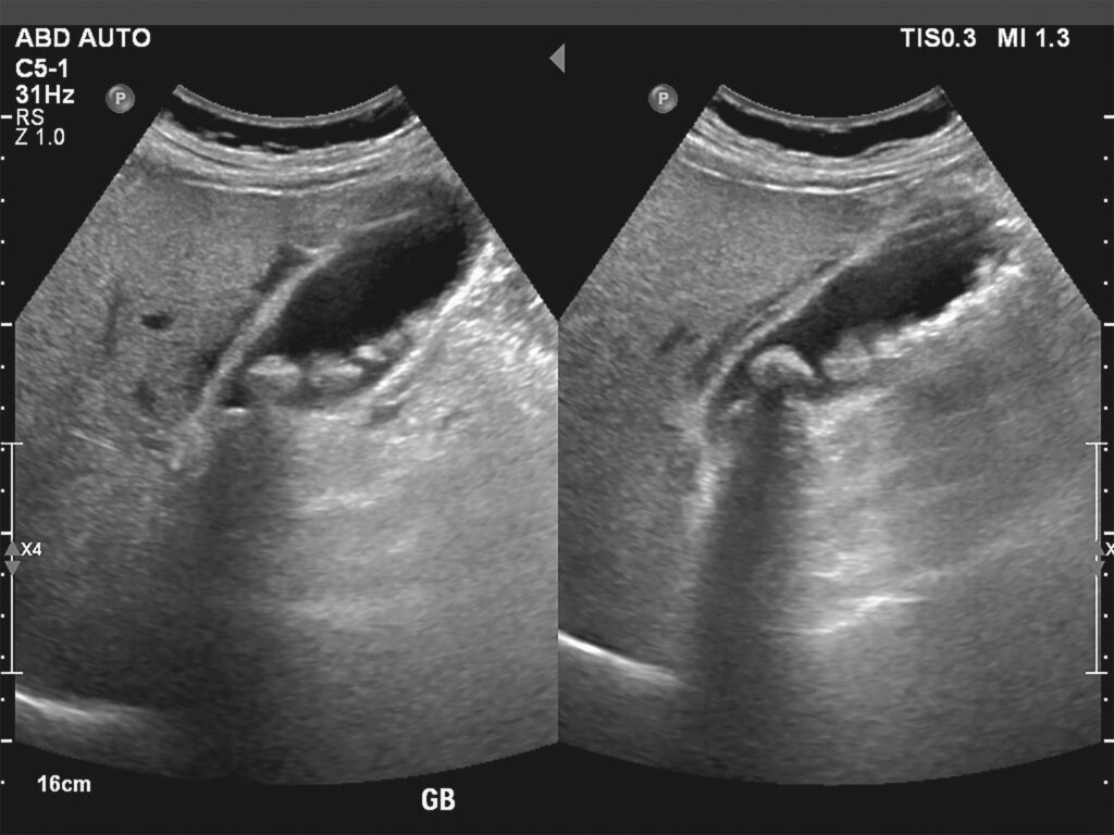 ultrasonography,image,of,gallbladder,with,gall,stones,at,upper,abdomen