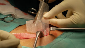 mesh,application,in,inguinal,hernia,repair,also,known,as,hernioplasty.